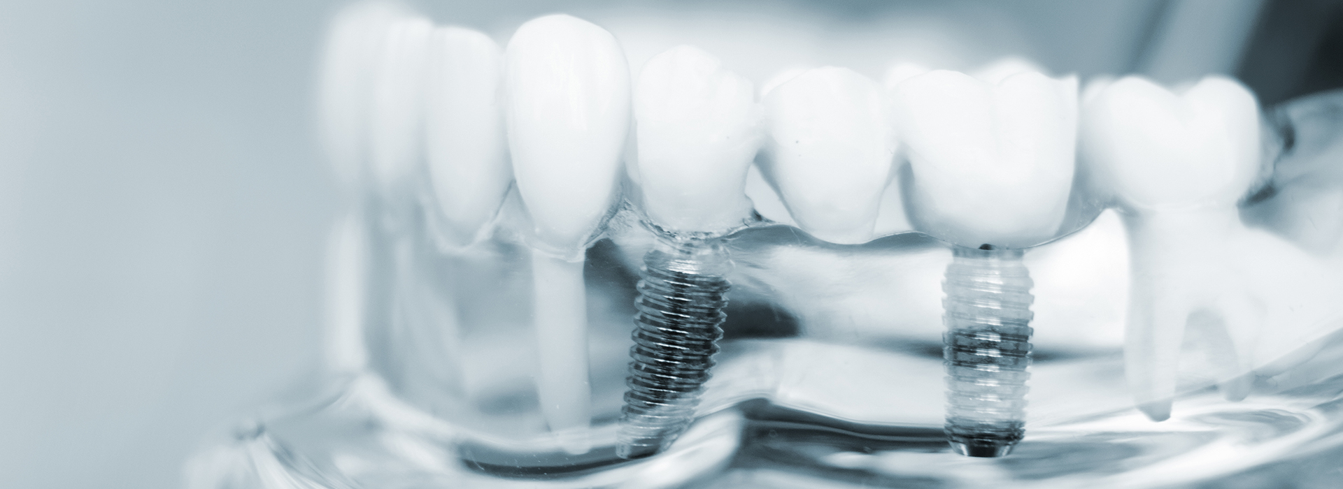Gregory J. Schmitt, DMD | Snoring Appliances, Root Canals and Crowns amp Caps